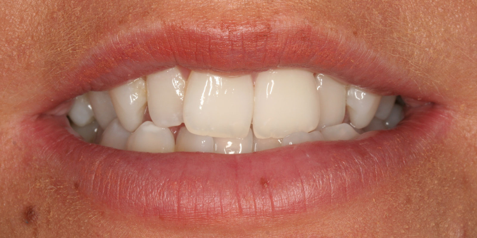 http://Invisalign%20Before