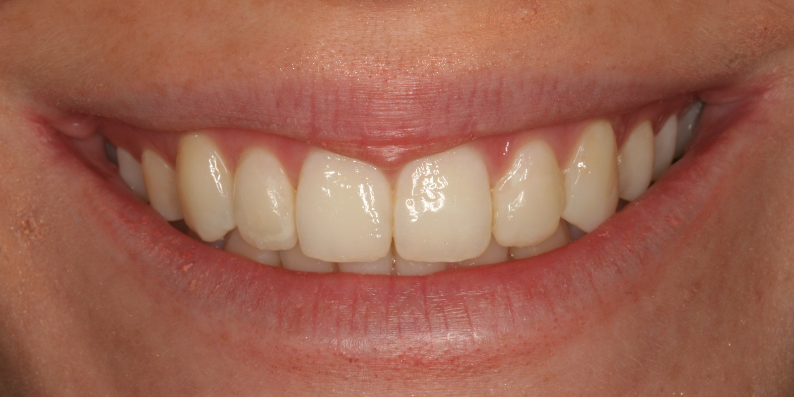 http://Smile%20Makeovers%20After