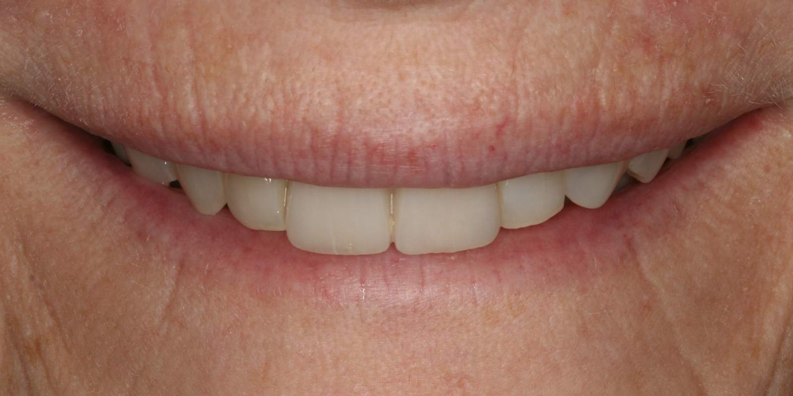 http://Smile%20Makeovers%20After