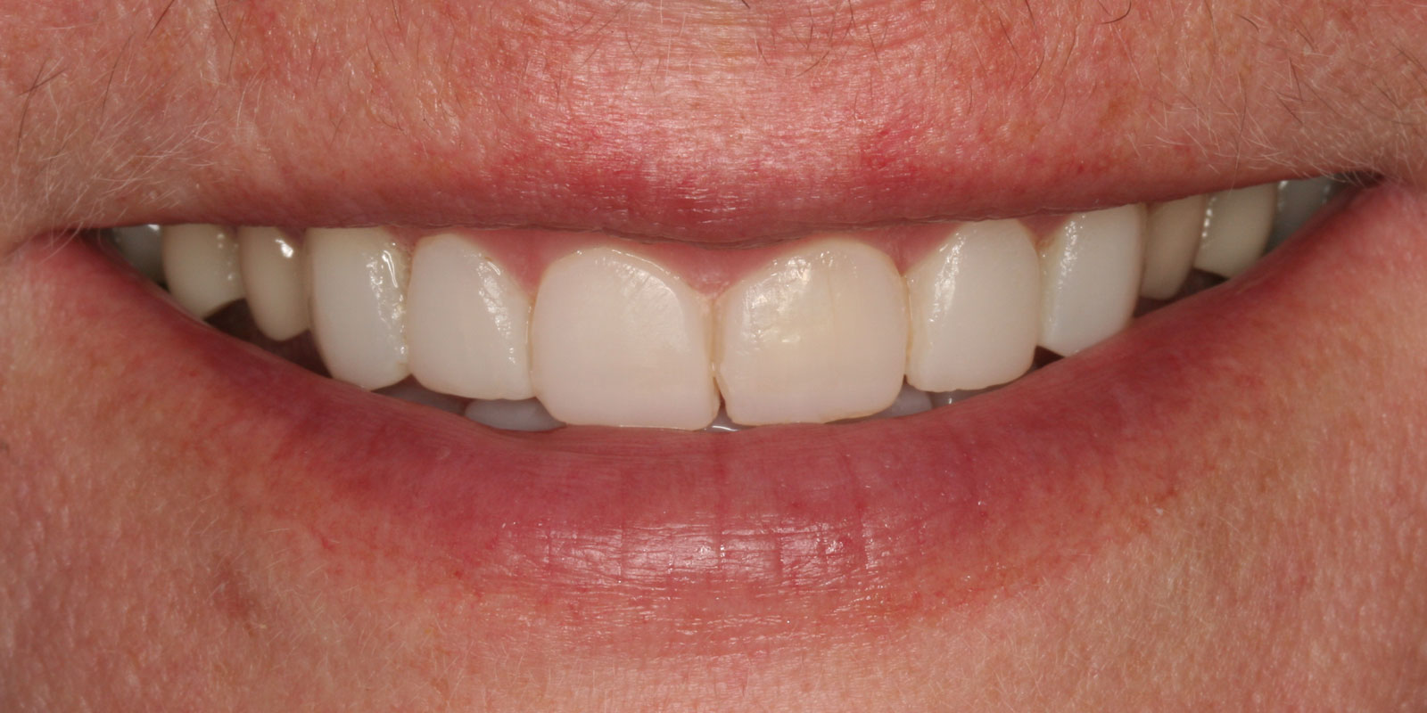 http://Composite%20bonding%20after