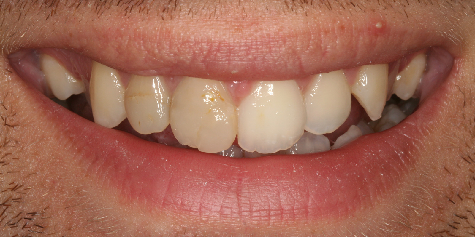 http://Veneers%20before